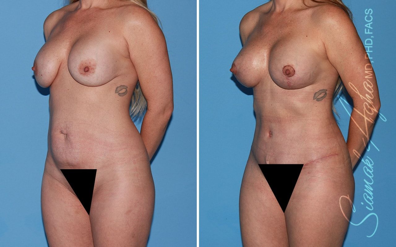 Mommy Makeover Before & After