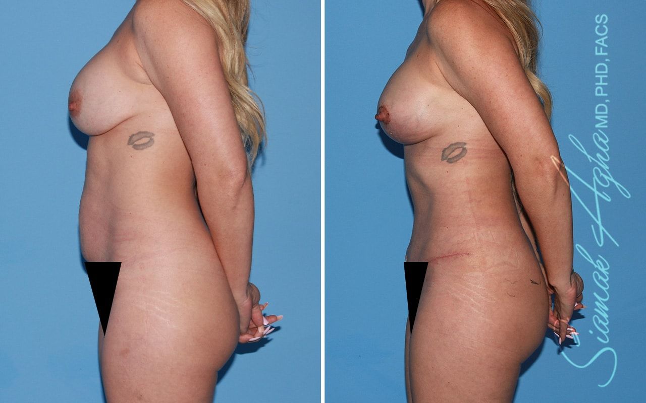 Mommy Makeover Before & After