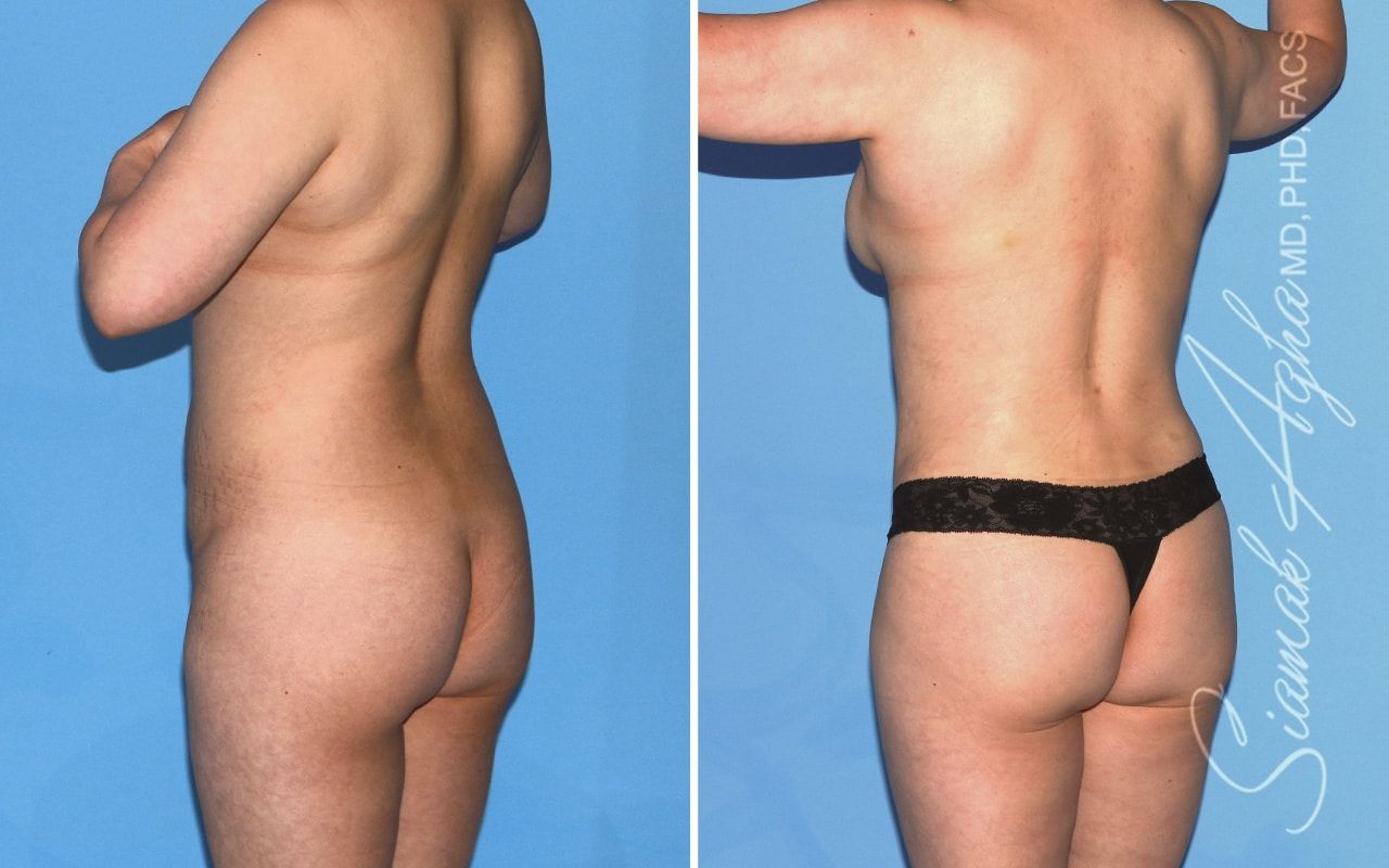 Mommy Makeover Before & After