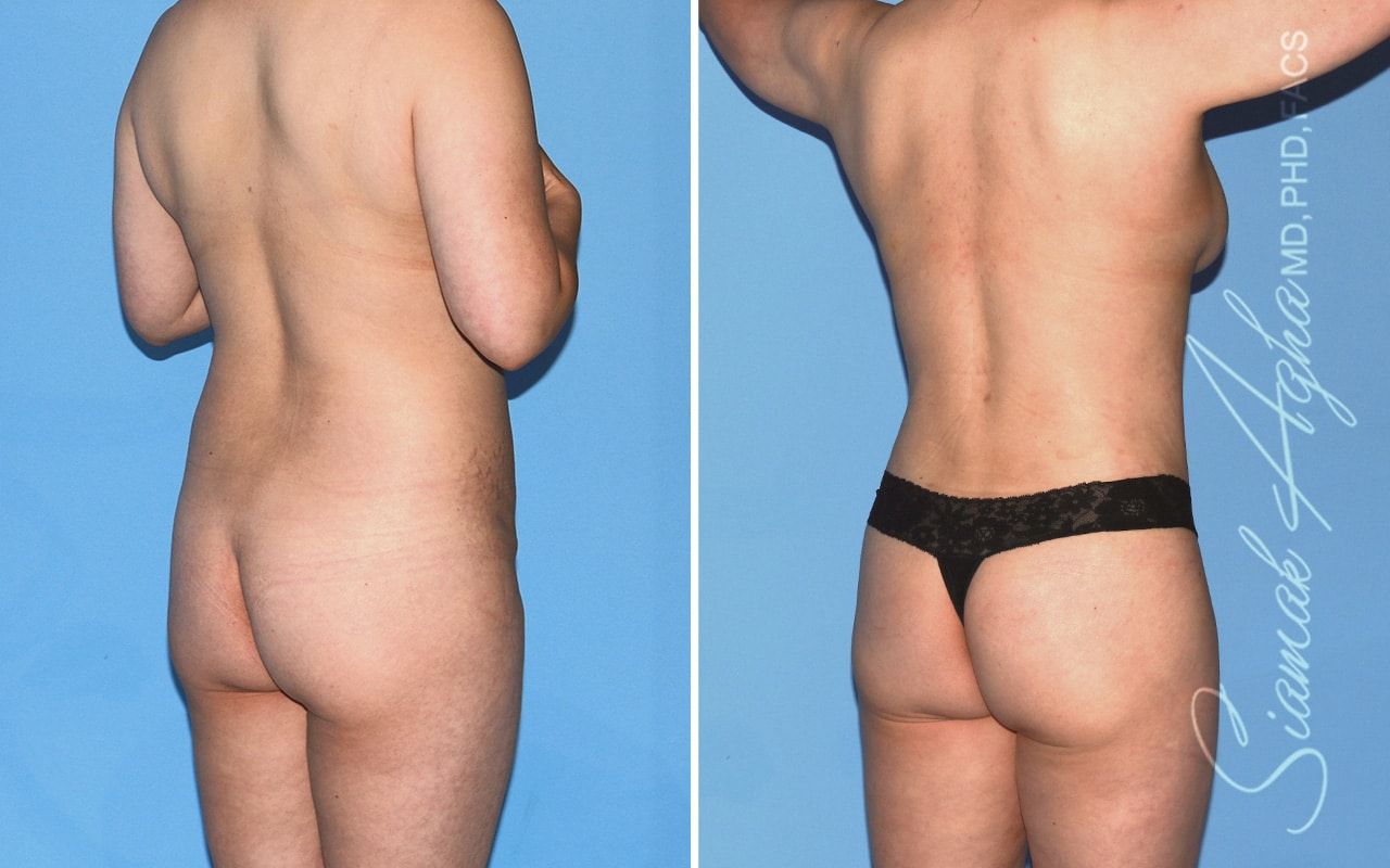 Mommy Makeover Before & After