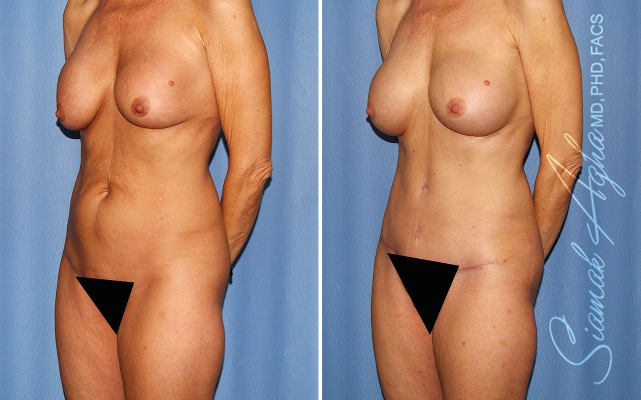 Mommy Makeover Before & After