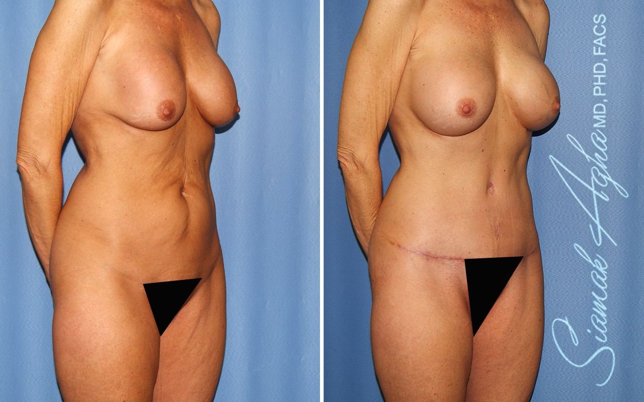 Mommy Makeover Before & After