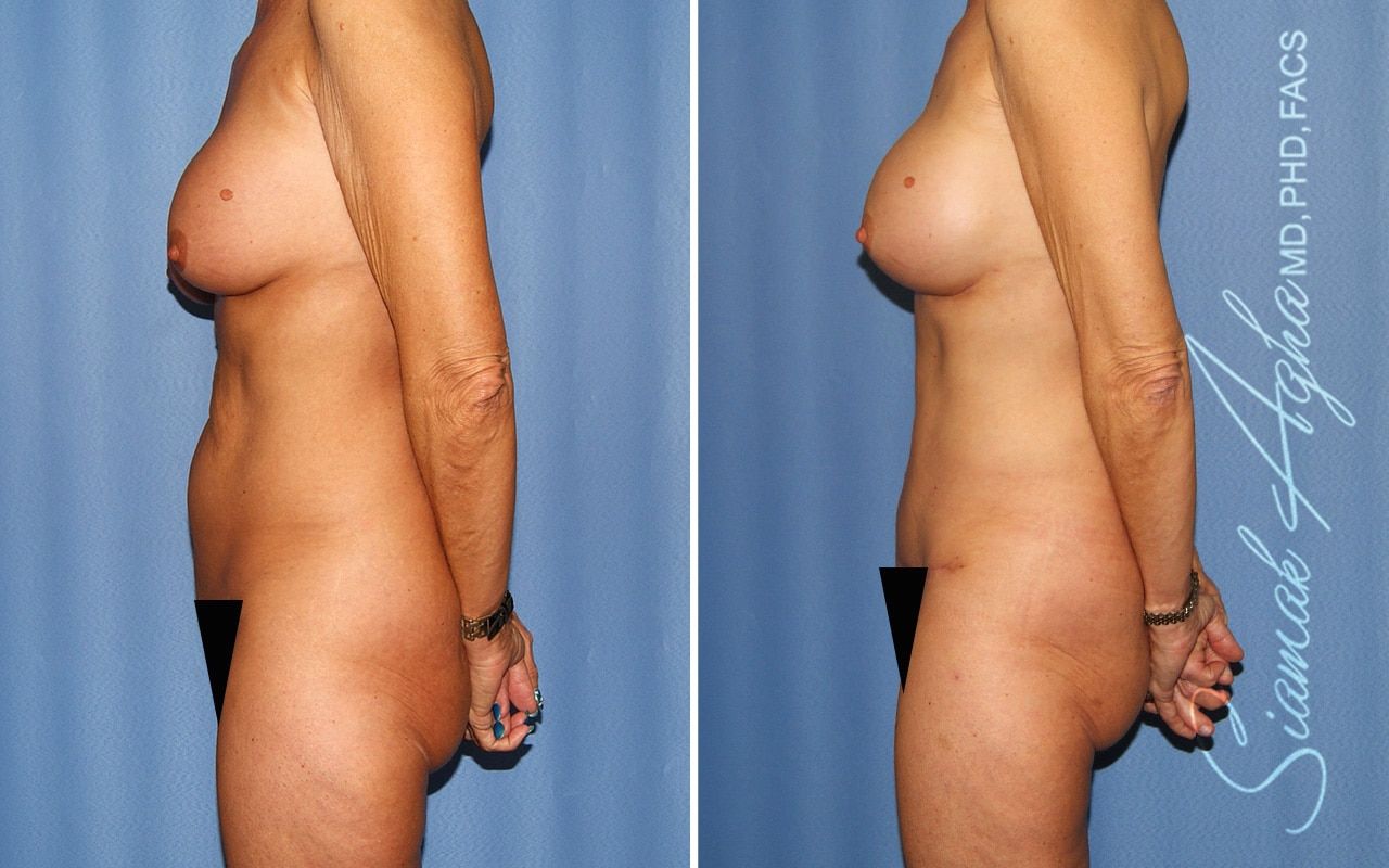 Mommy Makeover Before & After