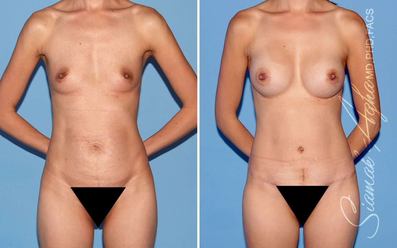 Mommy Makeover Before & After