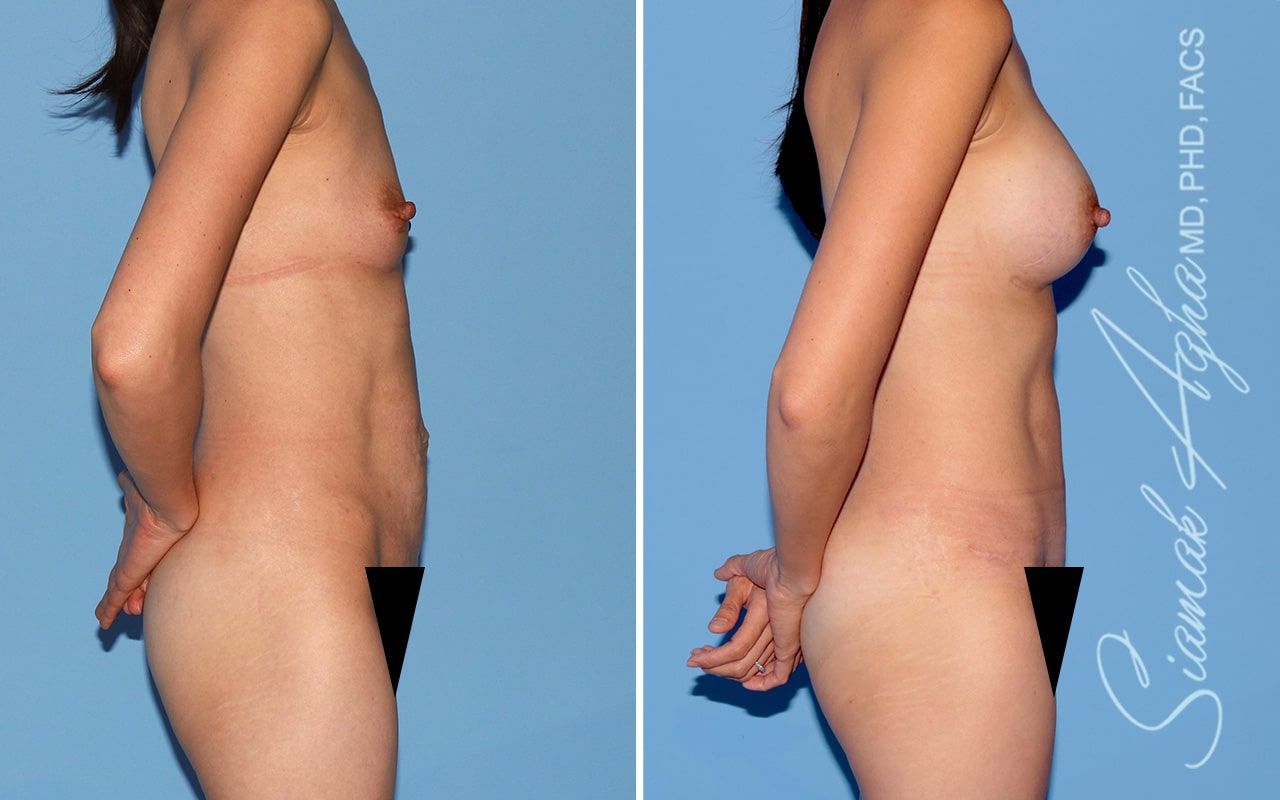 Mommy Makeover Before & After