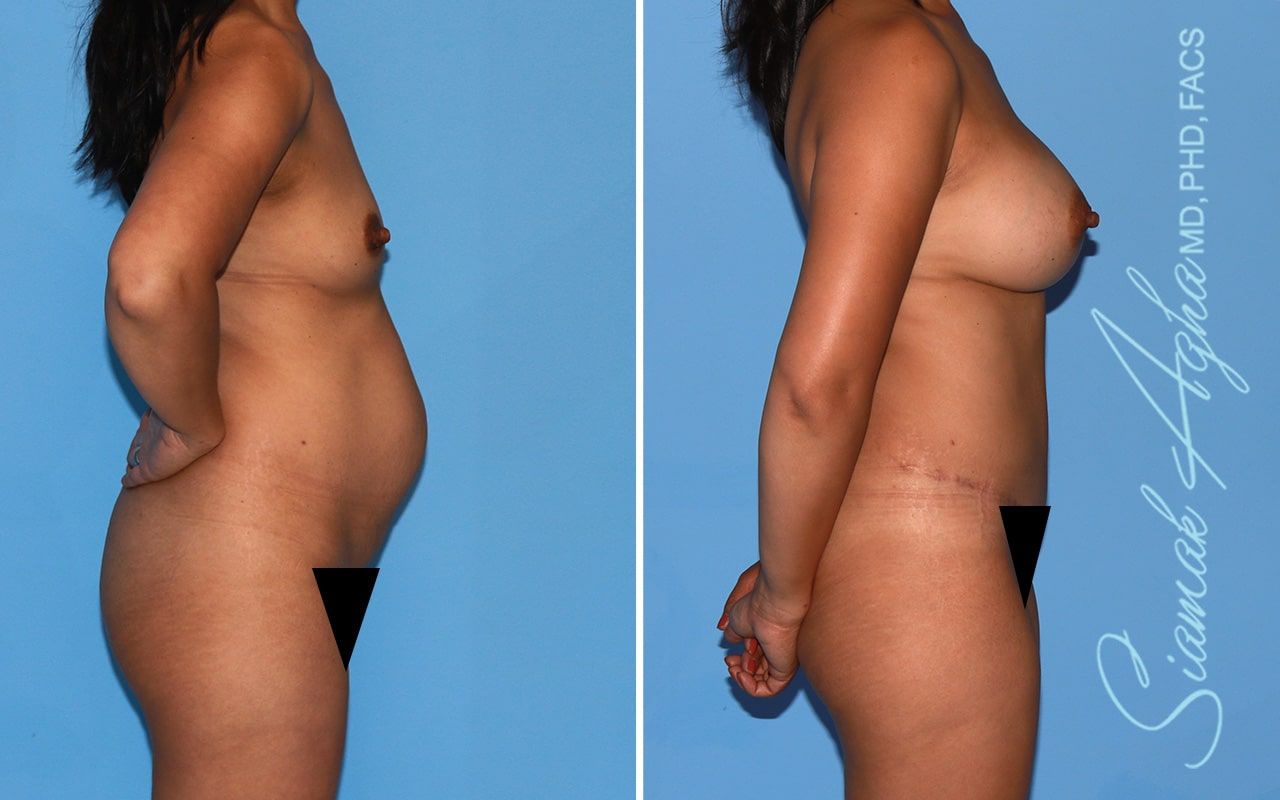 Mommy Makeover Before & After