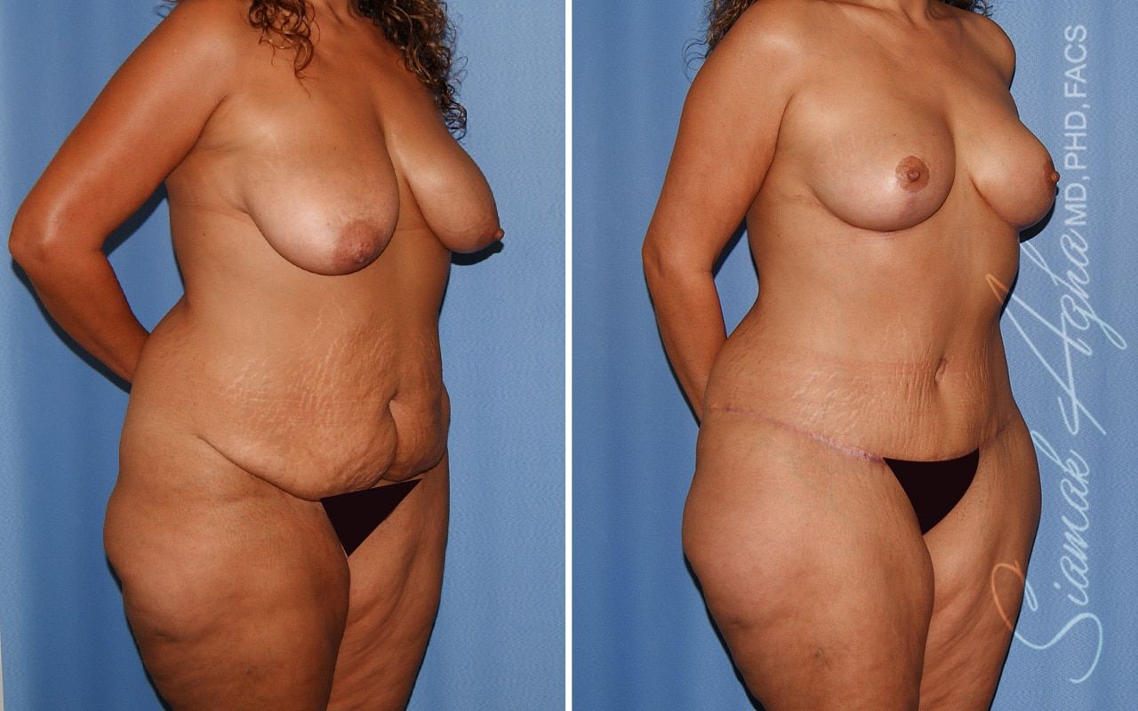 Mommy Makeover Before & After