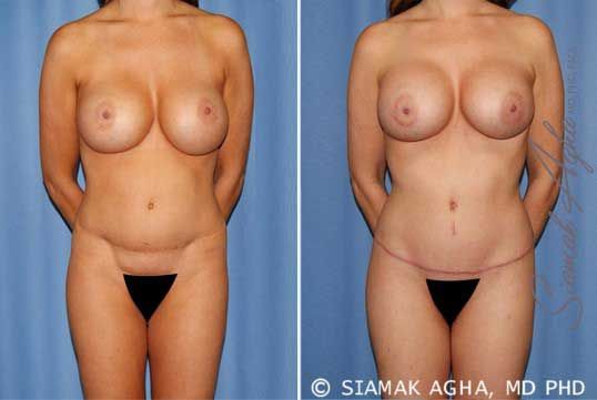 Mommy Makeover Before & After