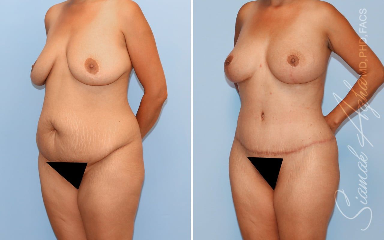 Mommy Makeover Before & After