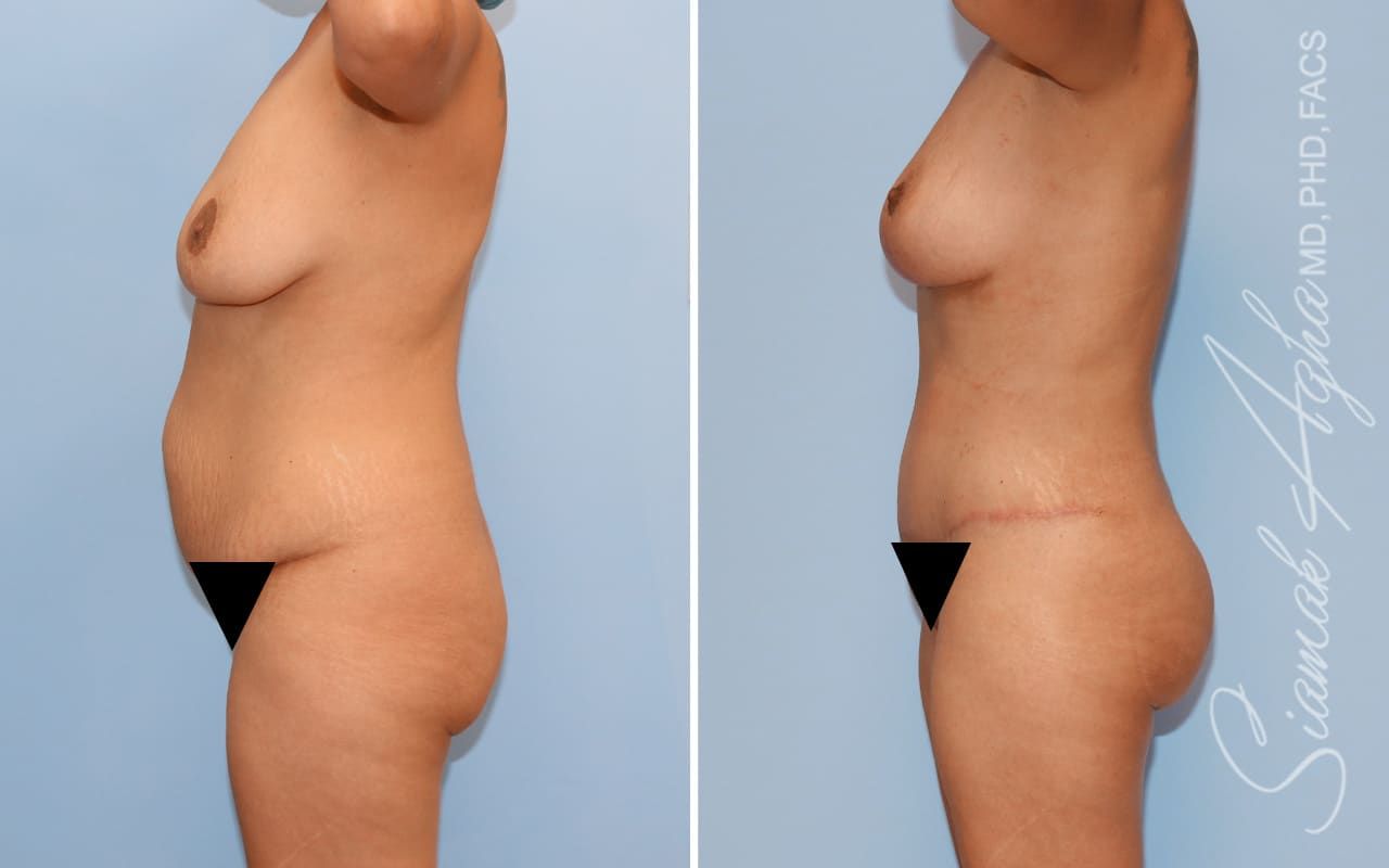 Mommy Makeover Before & After