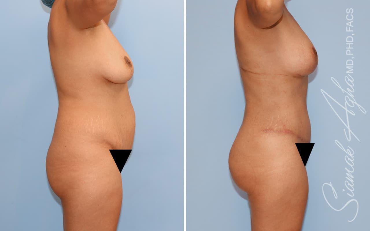 Mommy Makeover Before & After