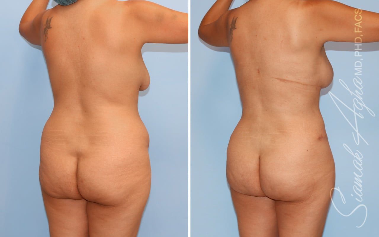 Mommy Makeover Before & After