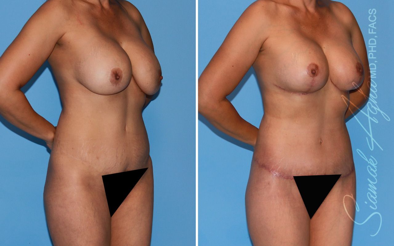 Mommy Makeover Before & After