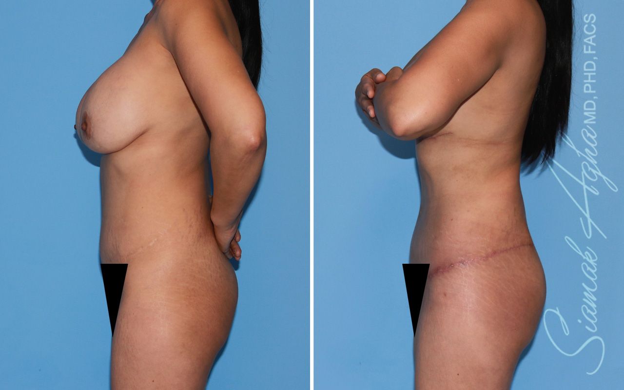 Mommy Makeover Before & After