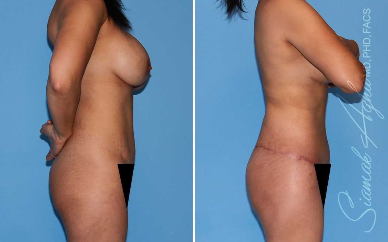 Mommy Makeover Before & After