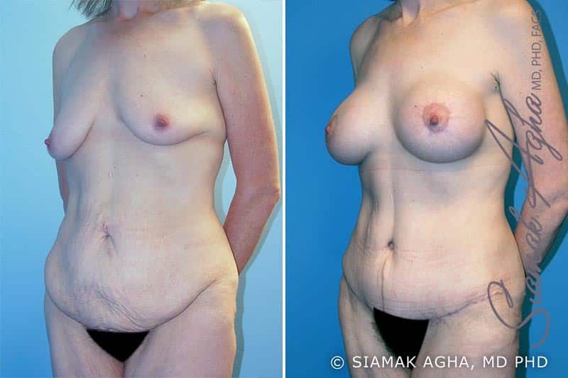 Mommy Makeover Before & After