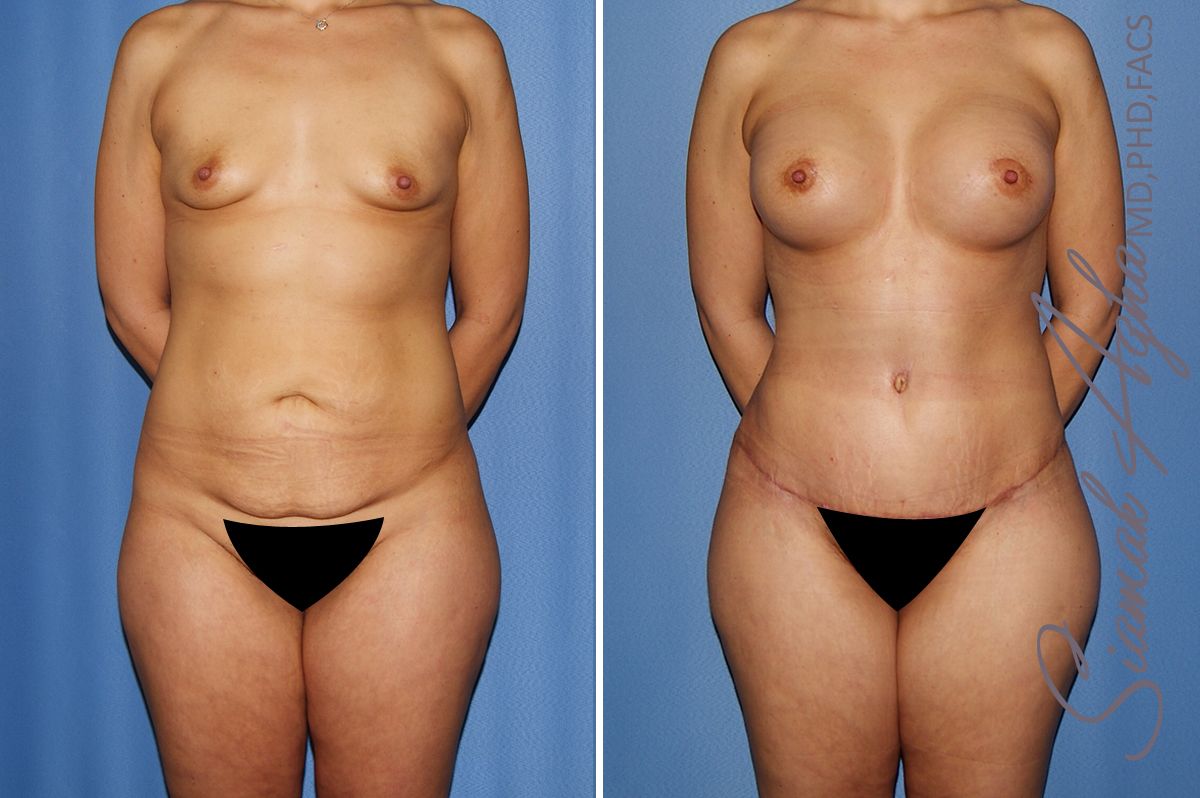 Mommy Makeover Before & After