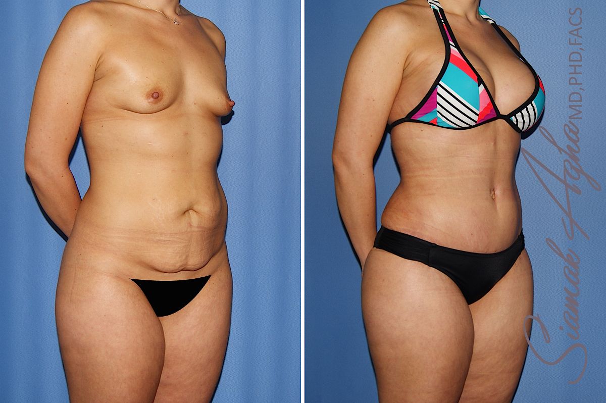 Mommy Makeover Before & After