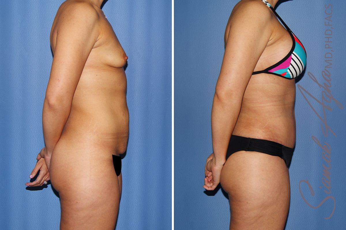 Mommy Makeover Before & After