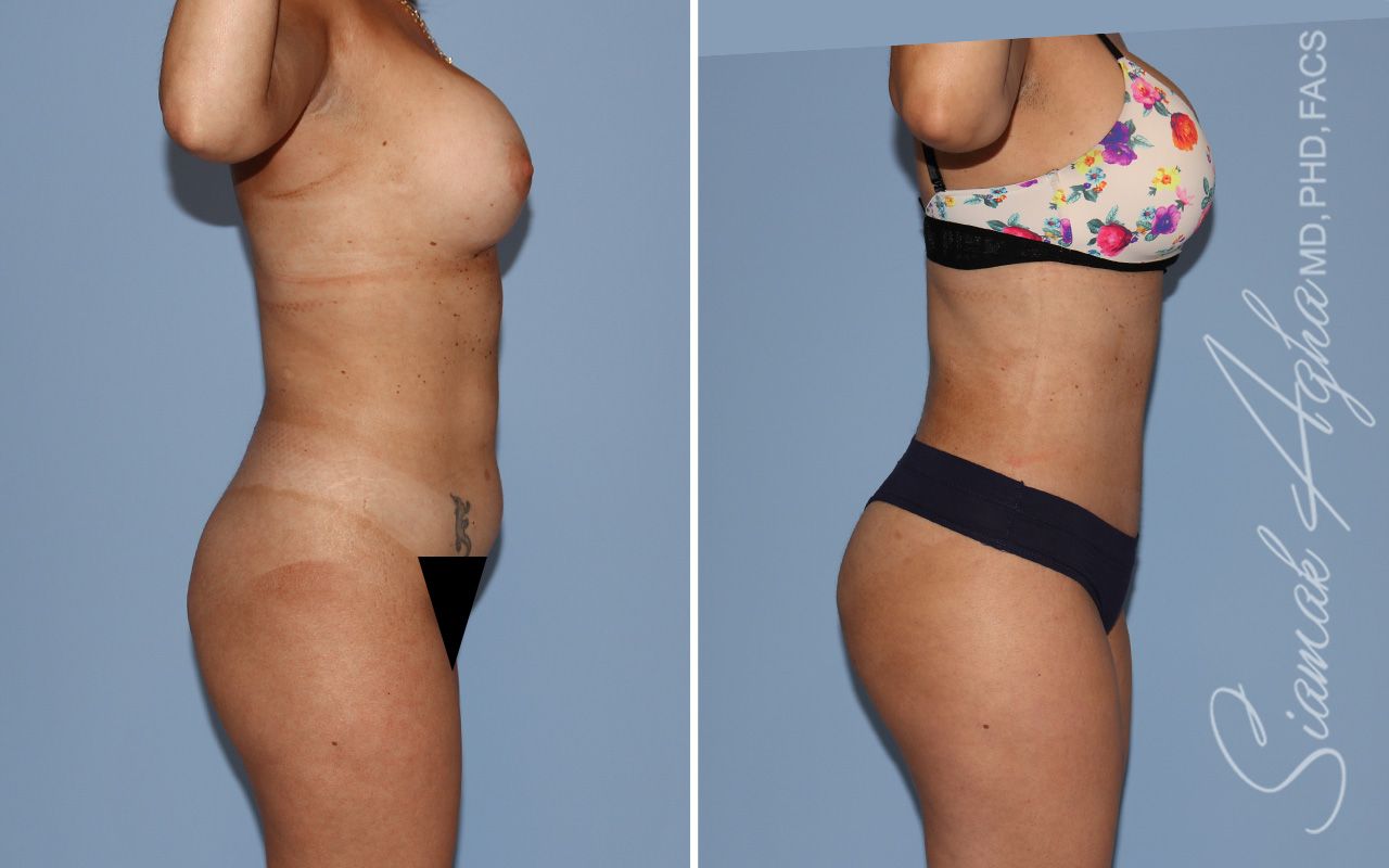 Mommy Makeover Before & After