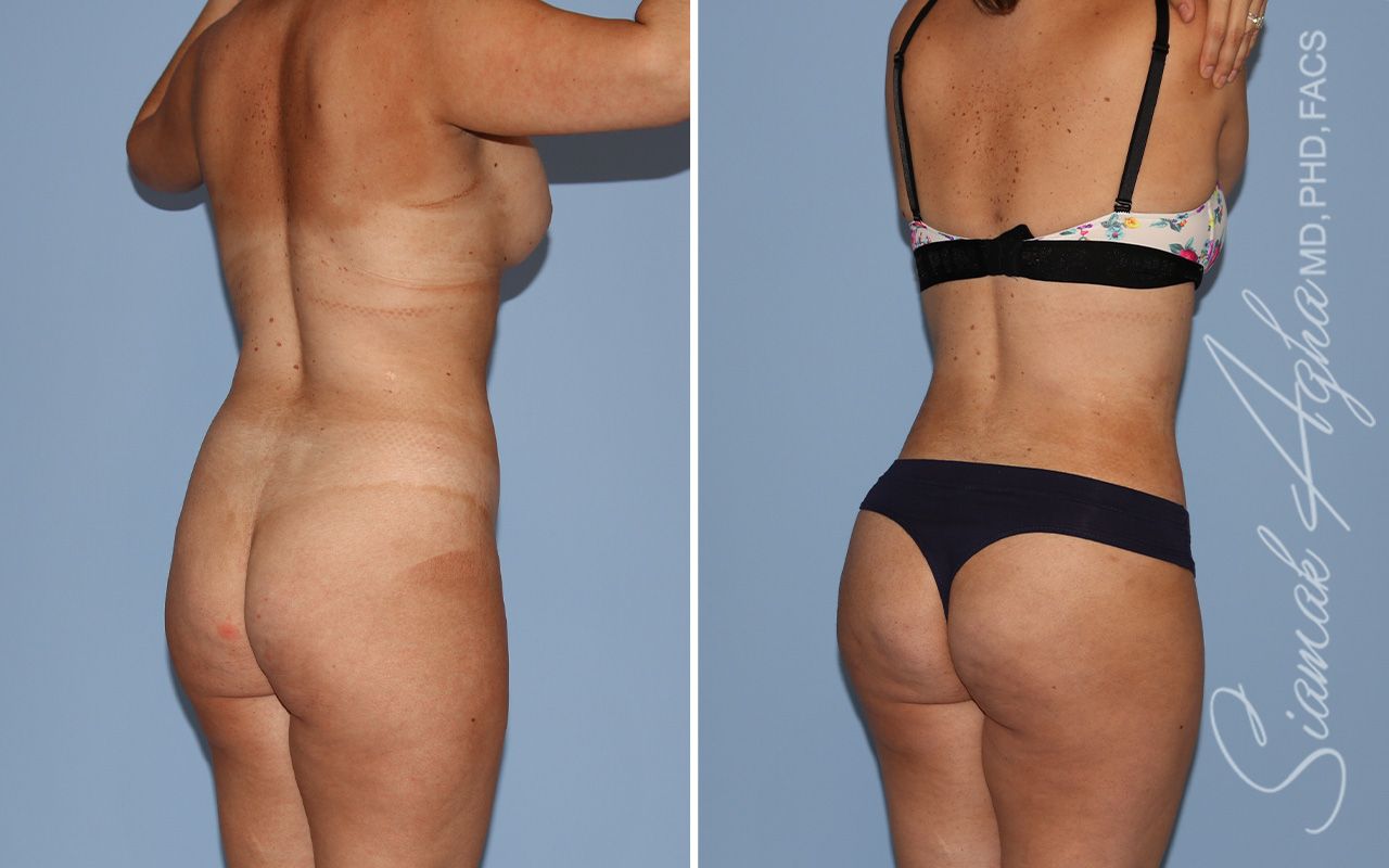 Mommy Makeover Before & After