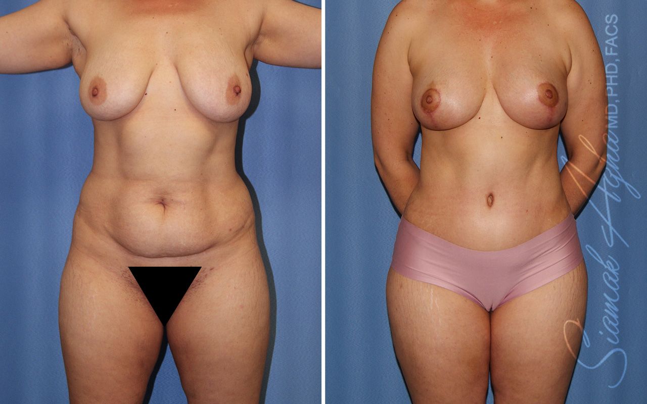 Mommy Makeover Before & After