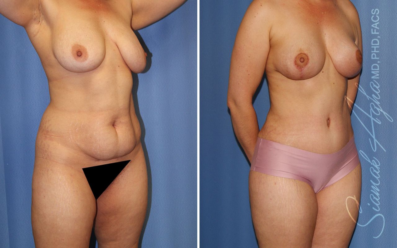 Mommy Makeover Before & After