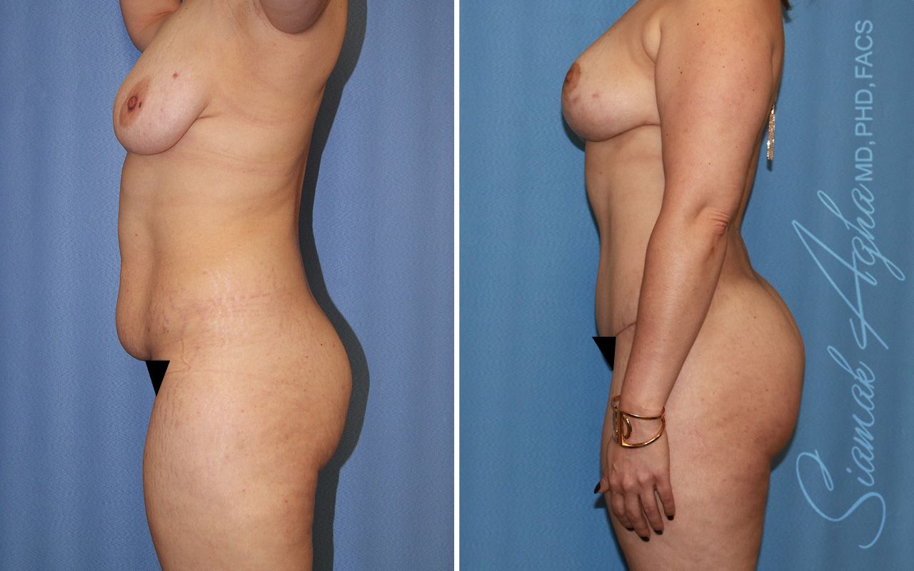 Mommy Makeover Before & After