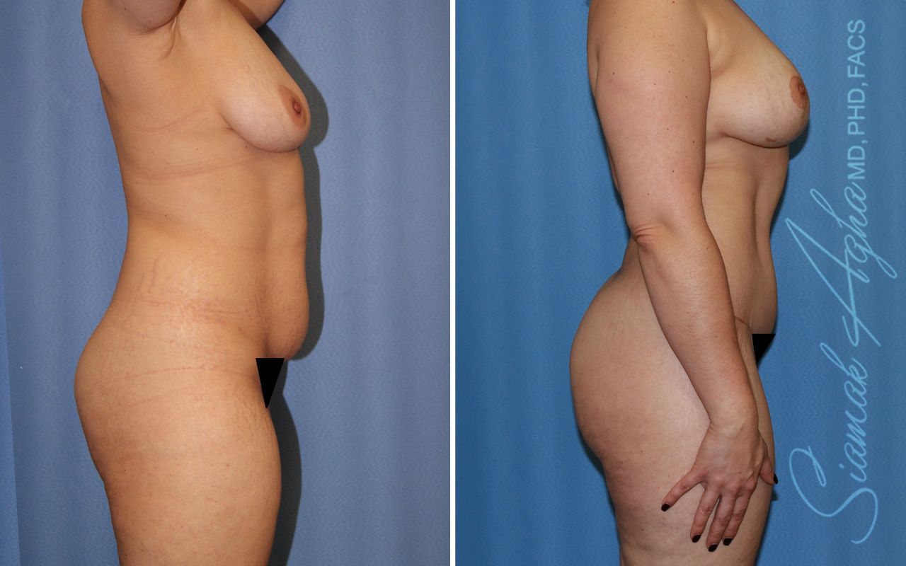 Mommy Makeover Before & After