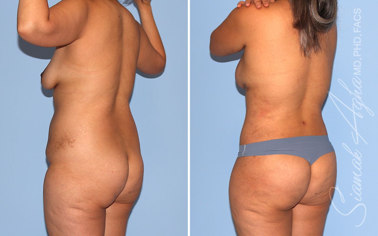 Mommy Makeover Before & After