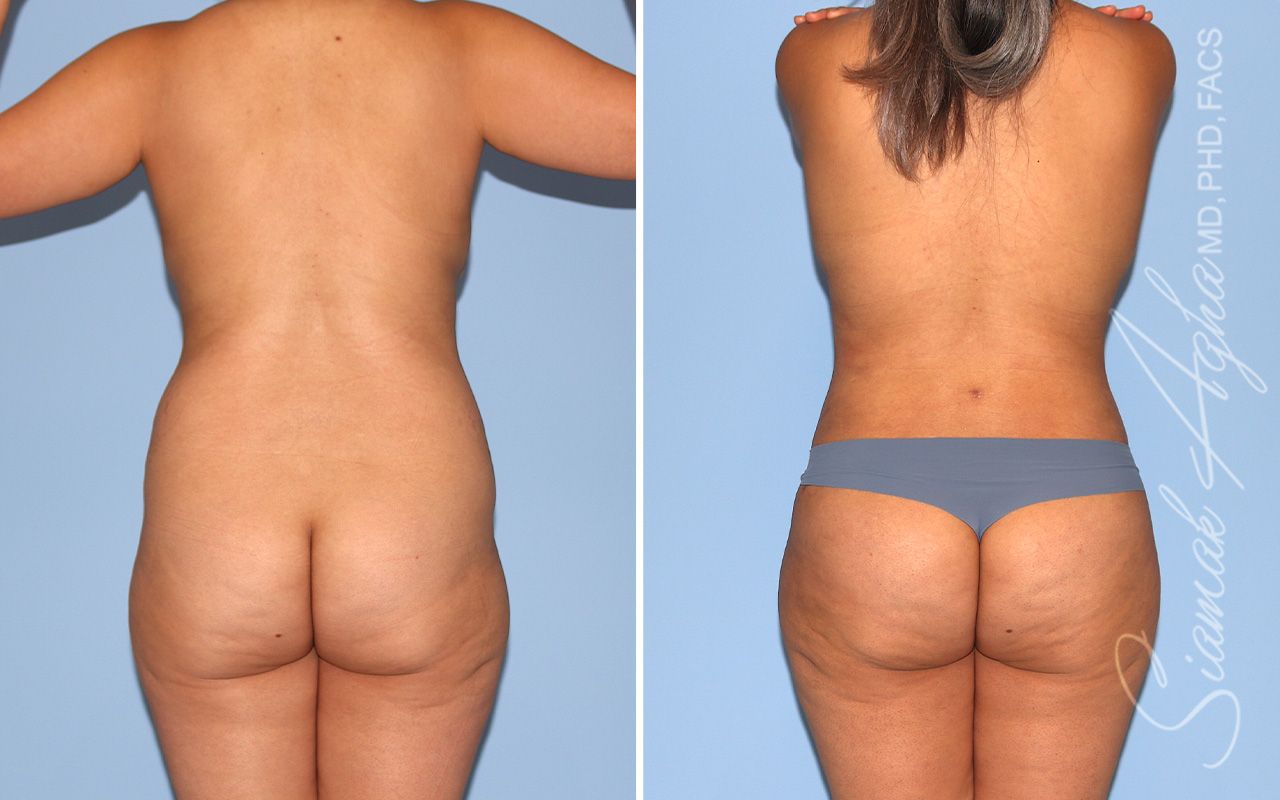 Mommy Makeover Before & After