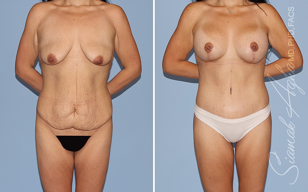 Mommy Makeover Before & After