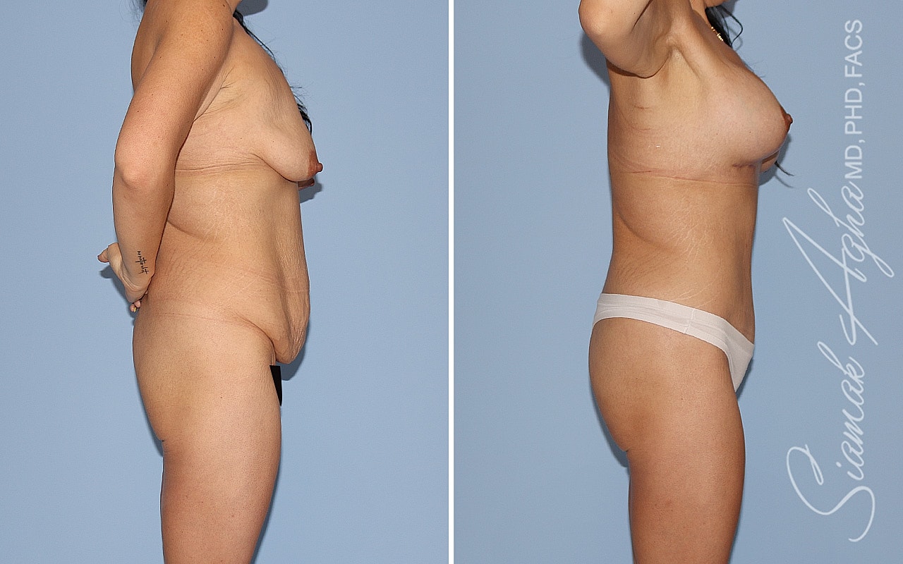 Mommy Makeover Before & After