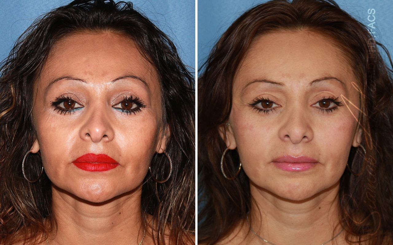 Cheek Lift Before & After