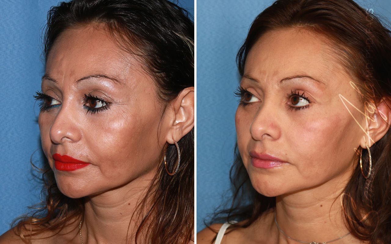 Cheek Lift Before & After
