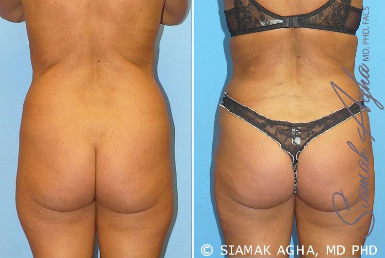 Brazilian Butt Lift Before & After
