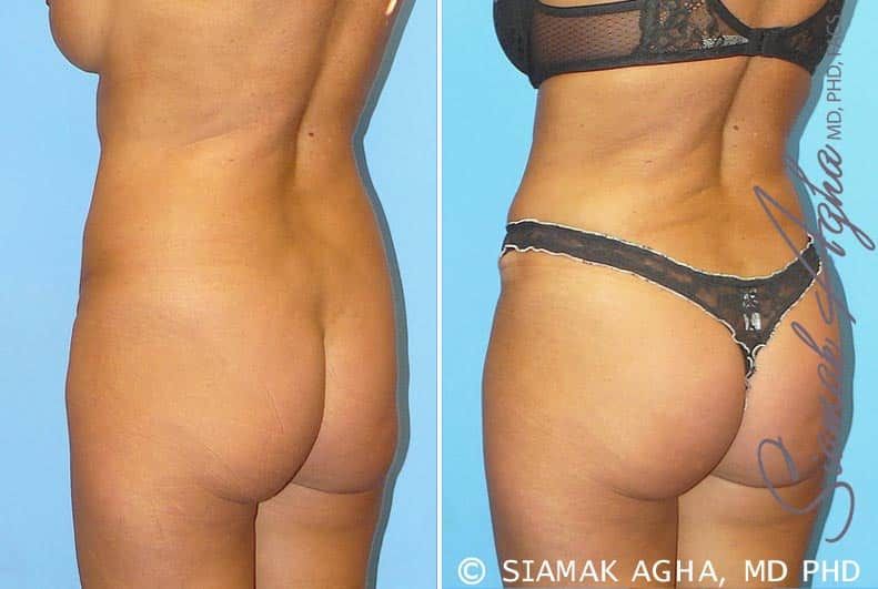 Brazilian Butt Lift Before & After