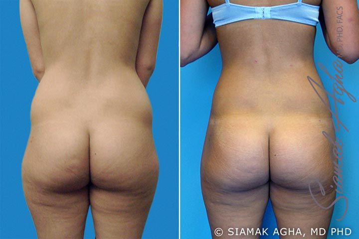 Brazilian Butt Lift Before & After