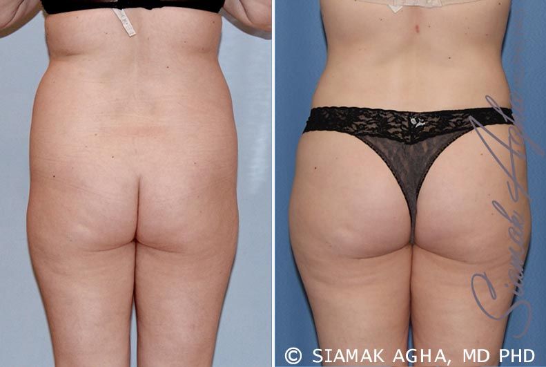 Brazilian Butt Lift Before & After