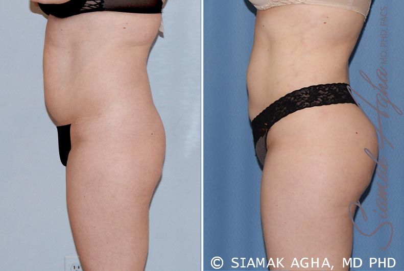 Brazilian Butt Lift Before & After