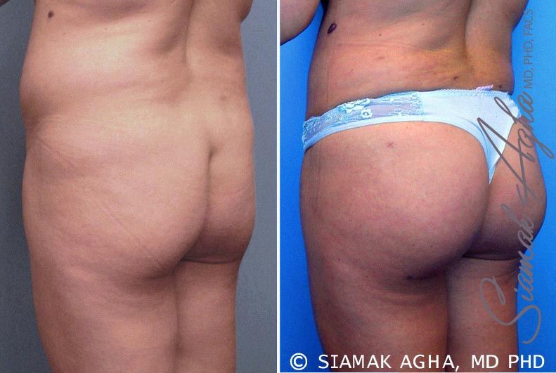 Brazilian Butt Lift Before & After