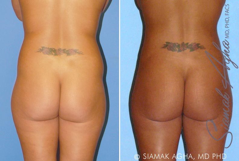 Brazilian Butt Lift Before & After
