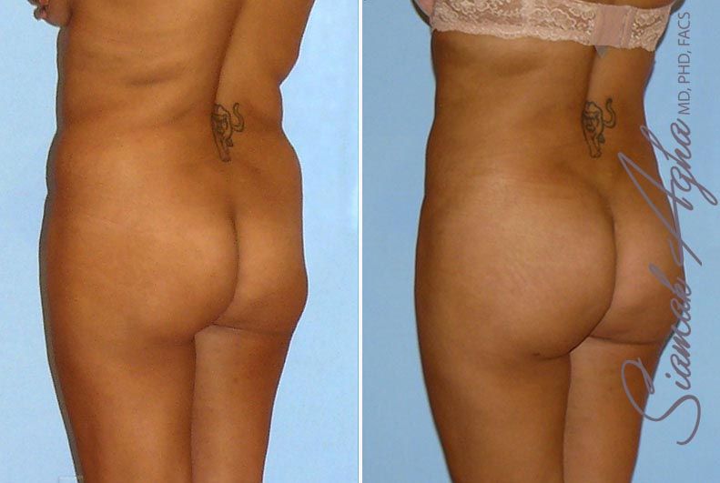 Brazilian Butt Lift Before & After