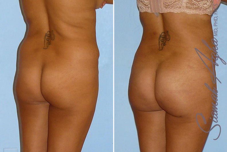 Brazilian Butt Lift Before & After