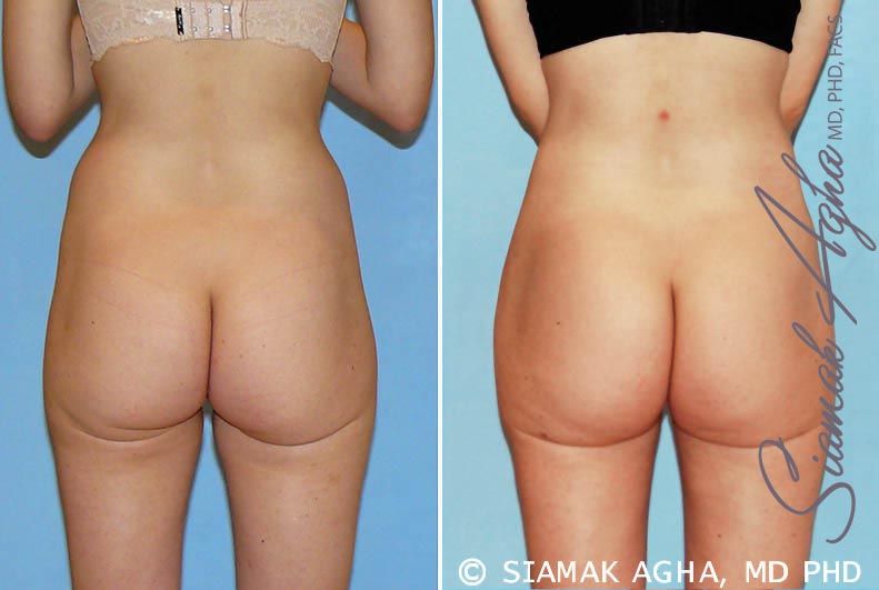 Brazilian Butt Lift Before & After