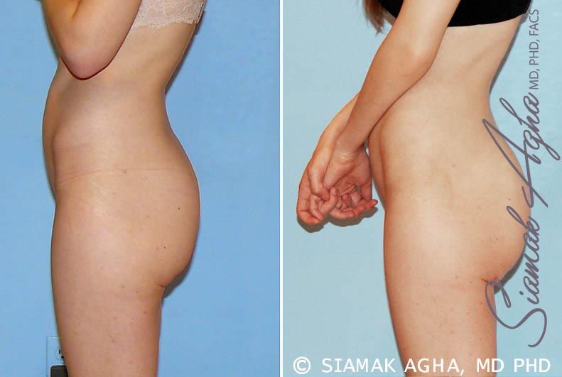 Brazilian Butt Lift Before & After