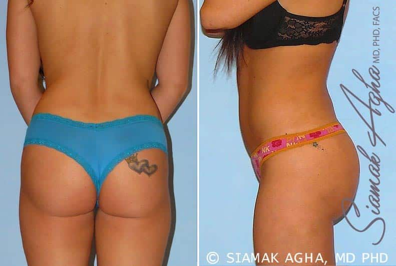 Brazilian Butt Lift Before & After