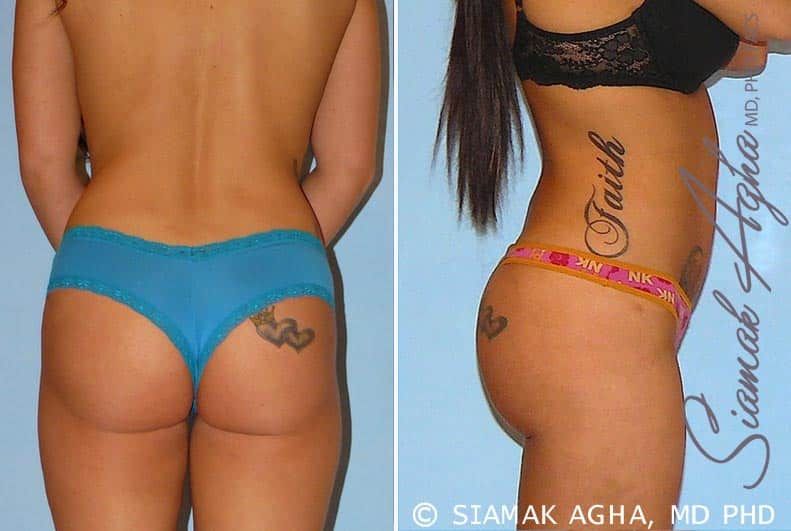 Brazilian Butt Lift Before & After