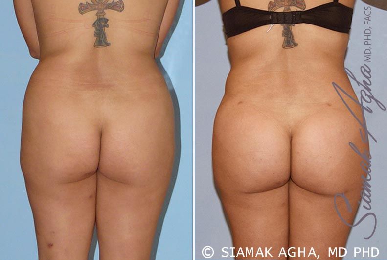 Brazilian Butt Lift Before & After