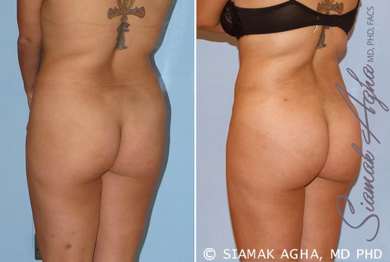 Brazilian Butt Lift Before & After